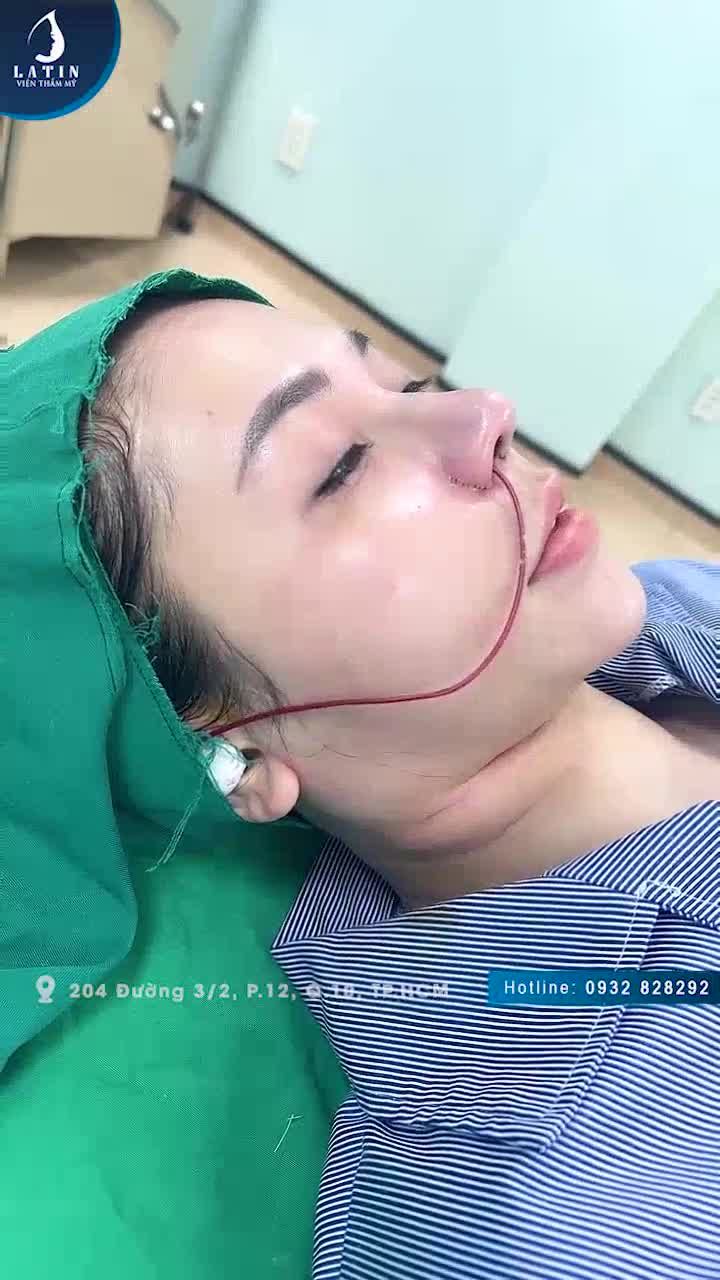 Bạn nào dáng mũi to bè, mũi gồ ghề thì xem ngay livestream này nhé!